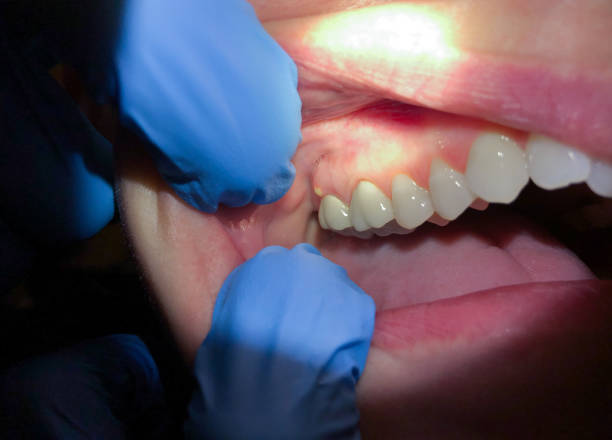 Best Knocked-Out Tooth Emergency  in Hill City, KS